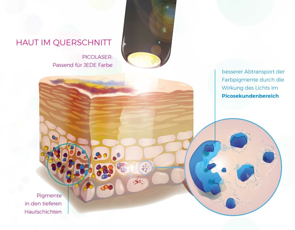 Grafik Laserbehandlung Picolaser