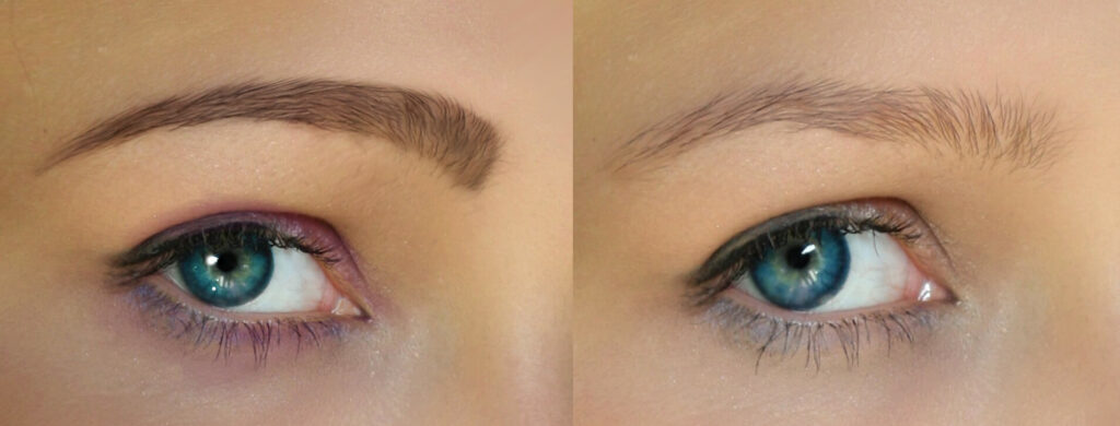 Removal of PMU eyebrows before after