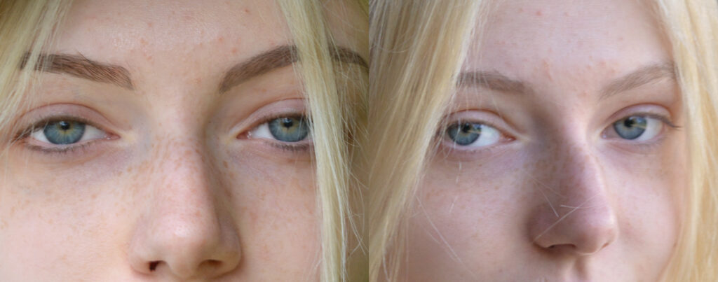 Laserentfernung Permanent MakeUp