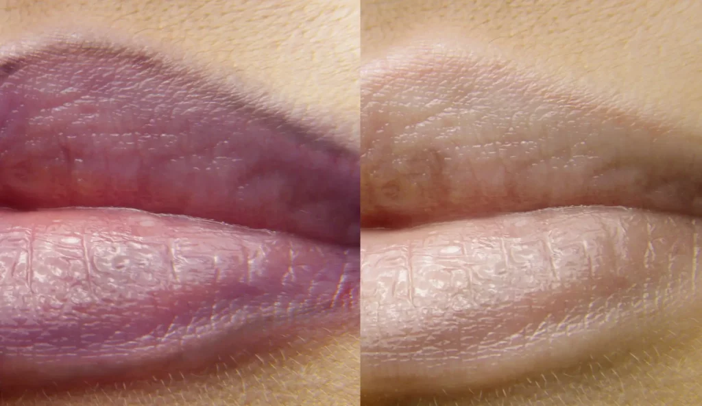 Removal of PMU  lips before after