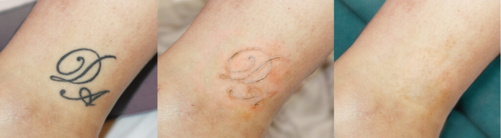 Overview Treatment process tattooremoval