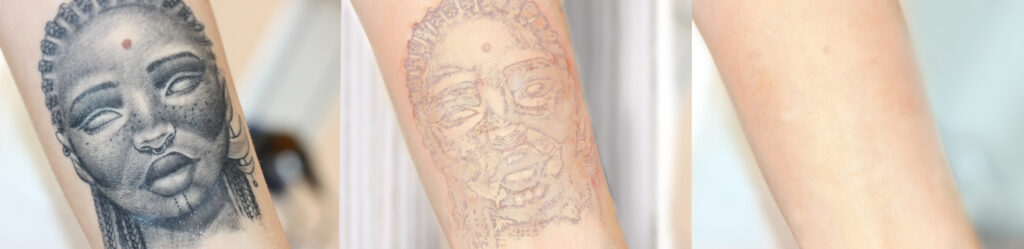 Overview Treatment process tattooremoval